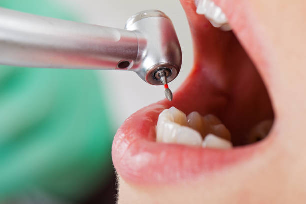 Best Emergency Dental Care for Broken or Chipped Teeth in South Beach, FL